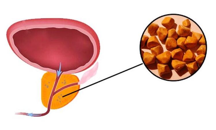 Калькулезный простатит что это. Кальцинаты предстательной железы. Калькулезный простатит. Хронический калькулезный простатит.