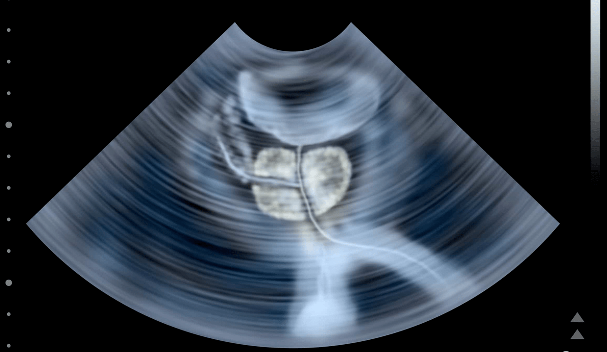 Taşlı prostatitin ultrason muayenesi