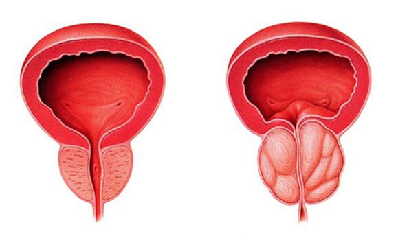Normal ve iltihaplı prostat (prostatit)