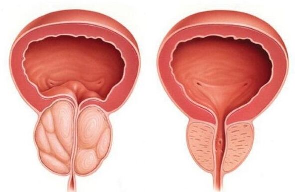prostatitli normal ve genişlemiş prostat